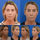 Face Glow 2.0® - Definição e Rejuvenescimento + Brinde